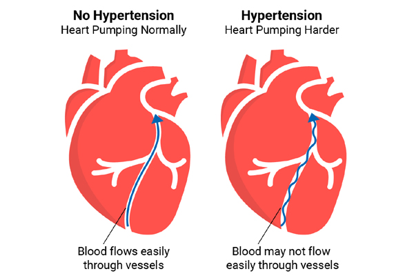 Hypertension
