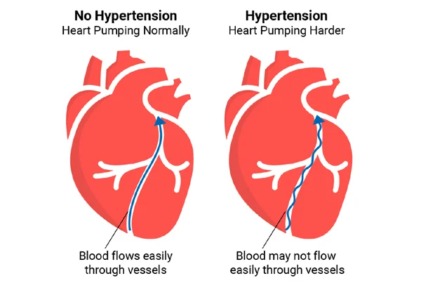 Hypertension